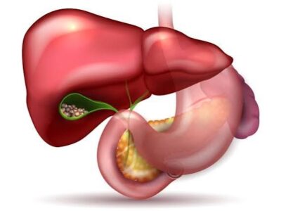 آیا مصرف عسل در درمان سنگ کیسه صفرا موثر است؟