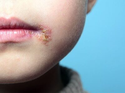 چه مداخلاتی برای درمان تبخال مؤثر است؟